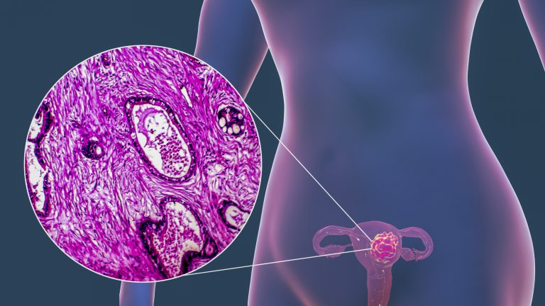 Imagem ilustrativa mostrando diagnóstico de câncer de colo de útero