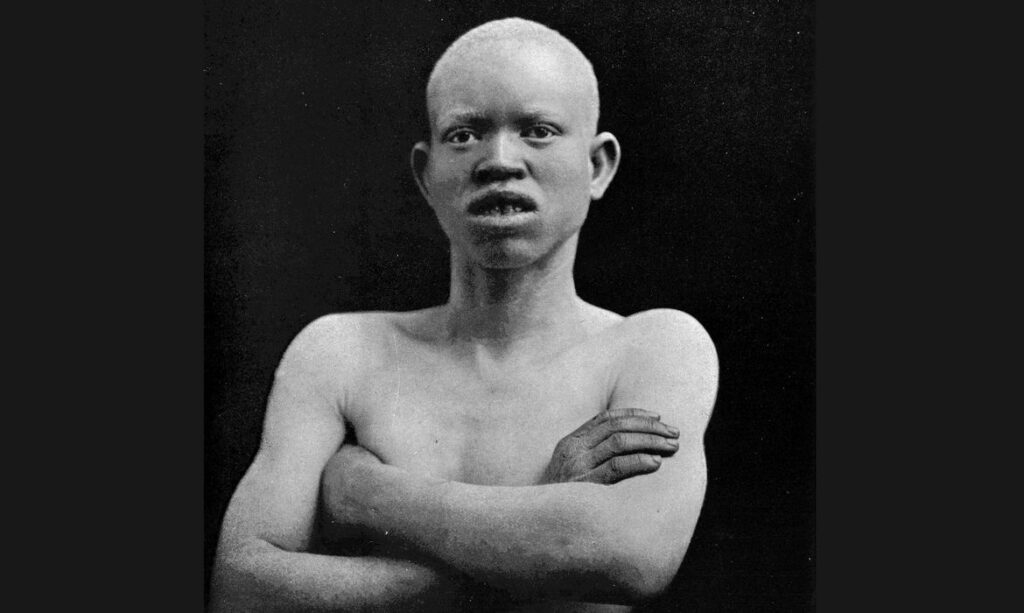 Brasília (DF) 13/06/2024 - Albino -Legenda original - Zulu Albino. A monograph on Albinism in man by
Karl Pearson and C. H. Usher. London: 1911. Plate
AA, fig. 86.
Published:  - 
Foto: @wellcome.ac.uk/WikImedia Commons