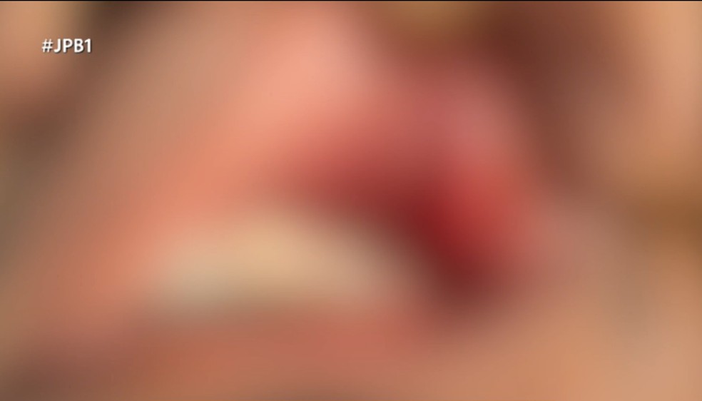 Boca do fisioterapeuta após agressão. Vítima não quis ser identificada — Foto: TV Cabo Branco/Reprodução