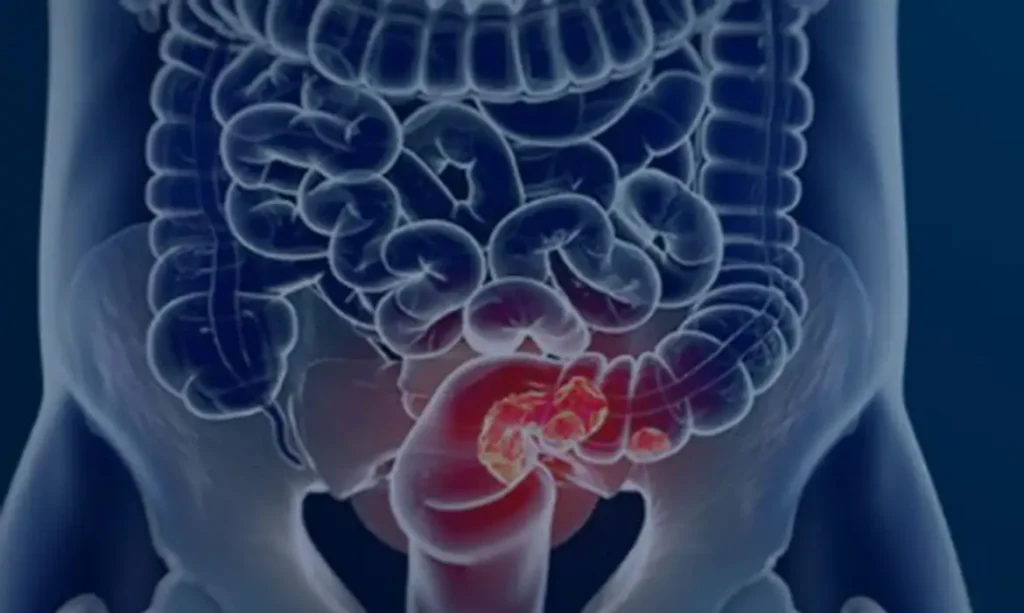 Brasília (DF) 04/08/2025 - Câncer colorretal. Foto: Câmara Municipal de Afonso Claudio/Divulgação