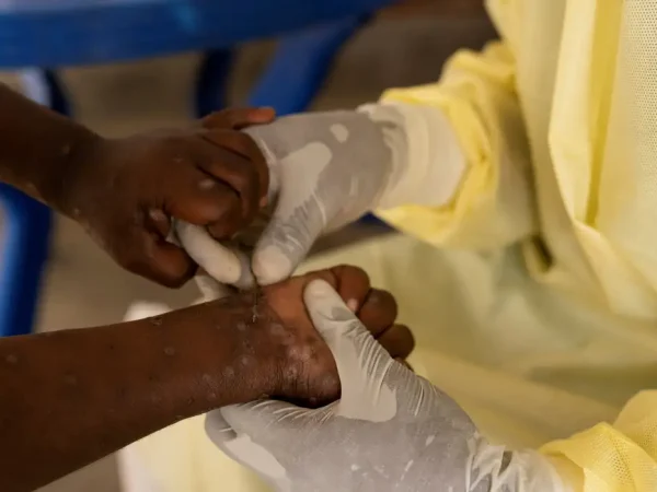 FILE PHOTO: Christian Musema, a laboratory nurse, takes a sample from a child declared a suspected case of Mpox  at the treatment centre in Munigi, following Mpox cases in Nyiragongo territory near Goma, North Kivu province, Democratic Republic of the Congo July 19, 2024. Reuters/Arlette Bashizi/Proibida reprodução
