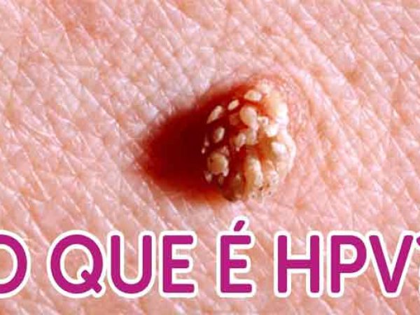 O HPV é a infecção sexualmente transmissível mais comum no mundo — Foto: Reprodução