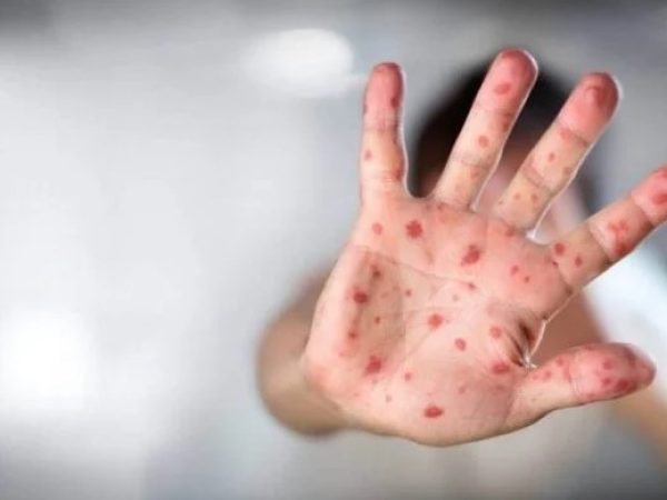Infecção é rara, mas gera alerta para a comunidade científica. Doença pode afetar adultos imunocomprometidos. — Foto: Reprodução