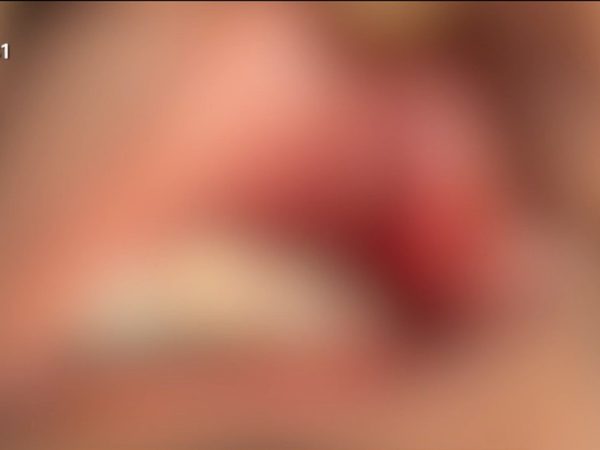 Boca do fisioterapeuta após agressão. Vítima não quis ser identificada — Foto: TV Cabo Branco/Reprodução