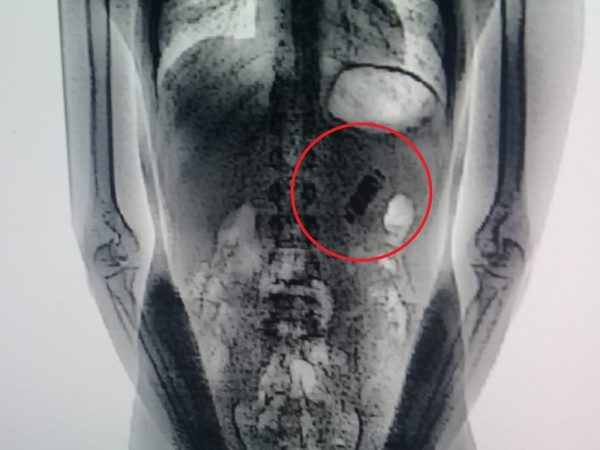 Homem passou por uma lavagem intestinal e uma endoscopia para retirar o celular do organismo. — Foto: Divulgação