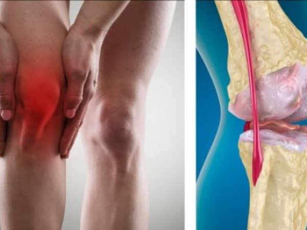 como-identificar-e-tratar-a-artrose-no-joelho-facebook