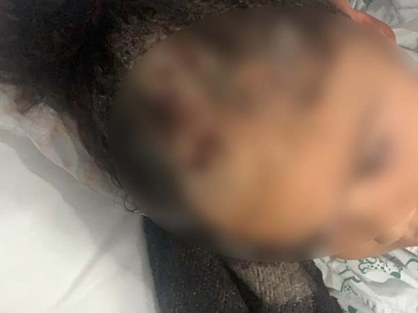 Acidente ocorreu em Praia Grande, litoral paulista. Vítima tem 3 anos e está internada em UTI após ocorrido — Foto: Aquivo pessoal