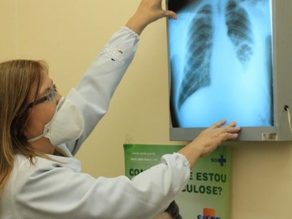 Exame para detectar tuberculose
