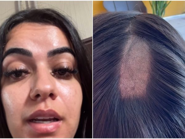 Mulher denuncia falha em exame toxicológico para CNH após ter parte da cabeça raspada em laboratório na PB — Foto: Reprodução