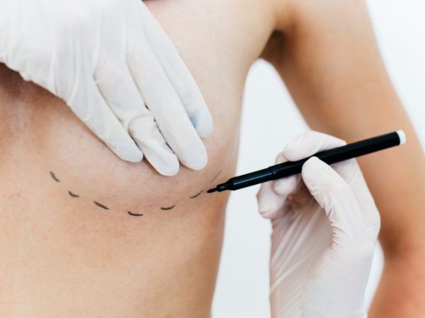 Médico faz marcação de cirurgia na mama de uma mulher