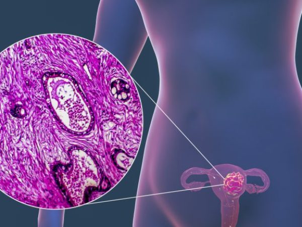 Imagem ilustrativa mostrando diagnóstico de câncer de colo de útero
