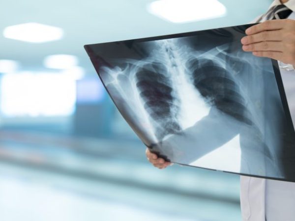 Na doença, vasos pulmonares são obstruídos por trombos organizados - GettyImages