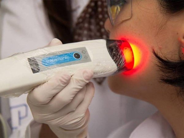Terapia fotodinâmica não invasiva para câncer e pele foi criada por cientistas do Instituto de Física de São Carlos da Universidade de São Paulo divulgação/Cepof