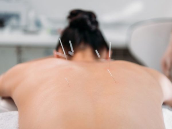 Saúde - geral - acupuntura
