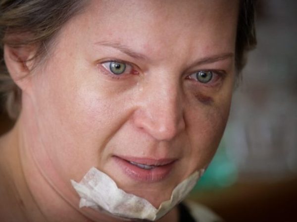 Deputada se recupera de cinco fraturas no rosto e uma na costela, além de alguns cortes pelo corpo. — Foto: Gustavo Moreno/Metrópoles