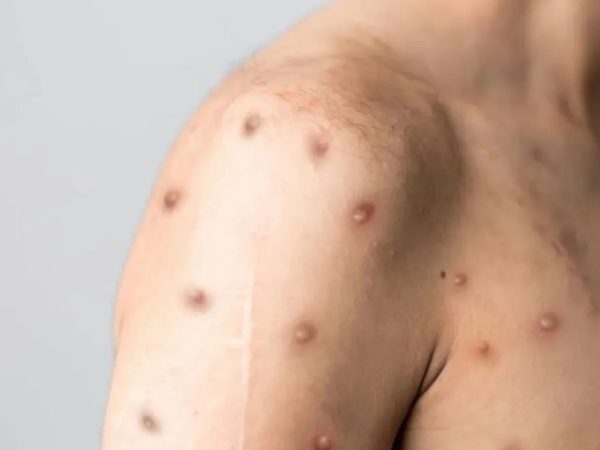 Mpox — Foto: Reprodução