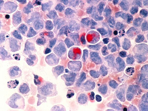 Câncer de células do sangue, Leucemia
