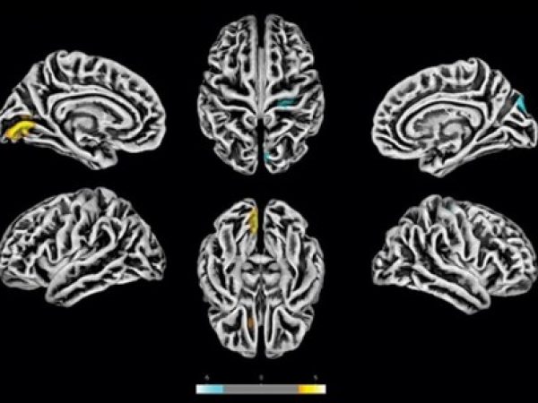 Exames de ressonância magnética feitos na Unicamp em 81 pacientes com sintomas neuropsiquiátricos pós-COVID revelam alterações na estrutura do córtex cerebral. As áreas em amarelo apresentam redução na espessura cortical. As marcas azuis correspondem a áreas com espessura aumentada — Foto: Divulgação