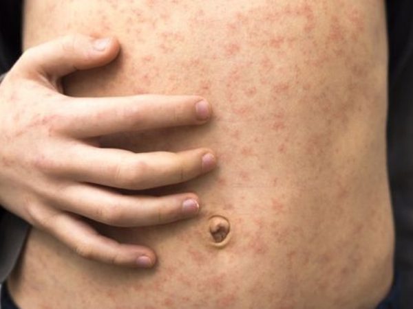 As manchas vermelhas são o sintoma mais óbvio do sarampo — Foto: Getty Images via BBC