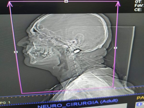 Bala ficou alojada na cabeça e vítima vai passar por cirurgia. Caso aconteceu neste sábado (14) — Foto: Reprodução/Inter TV Cabugi