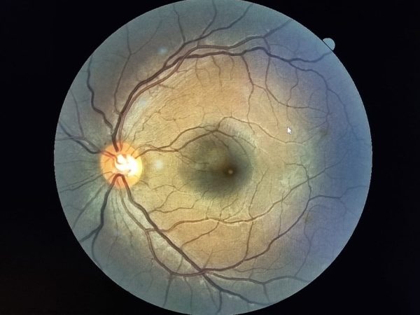 Potiguar de 22 anos teve lesão na retina de um dos olhos após olhar para o eclipse solar anular sem proteção. — Foto: Foto: Cedida