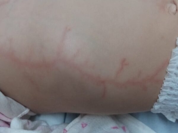 Pai, filho e sobrinha de 1 ano ficam feridos após queda de raio no interior do RN — Foto: Cedida